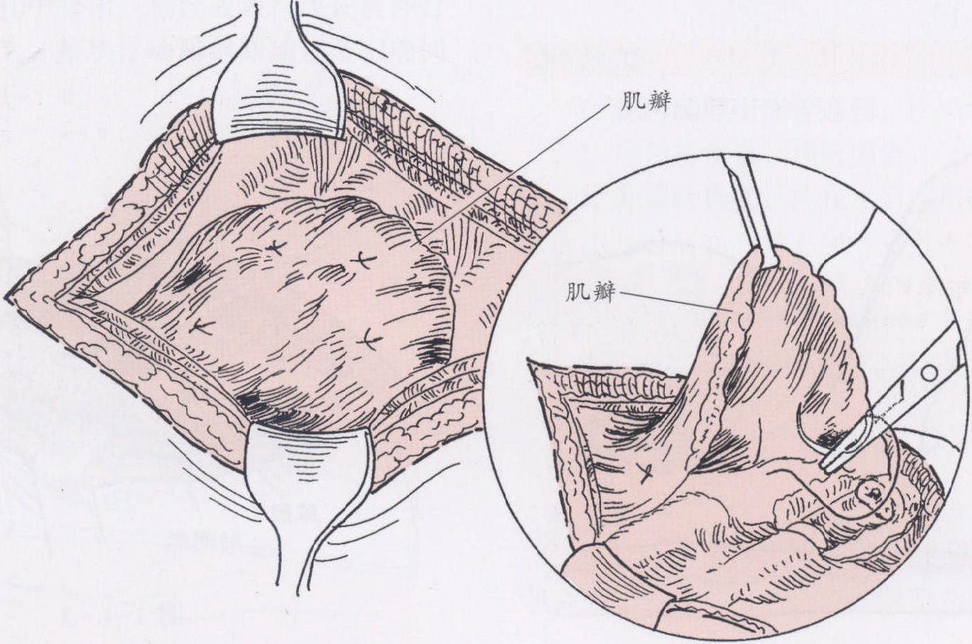 第六节 胸壁结核病灶清除术